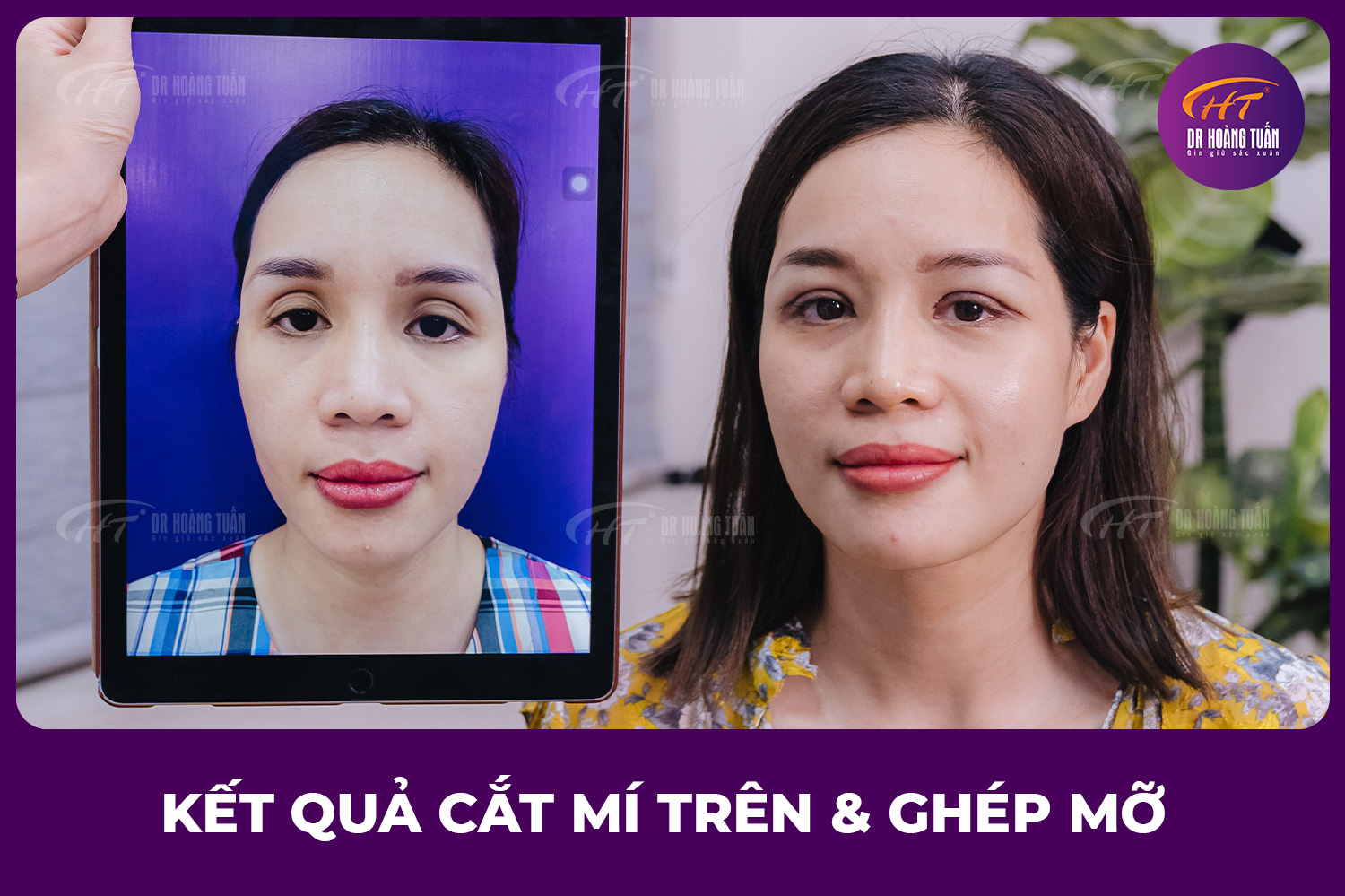 Cắt mí trên đẹp tự nhiên